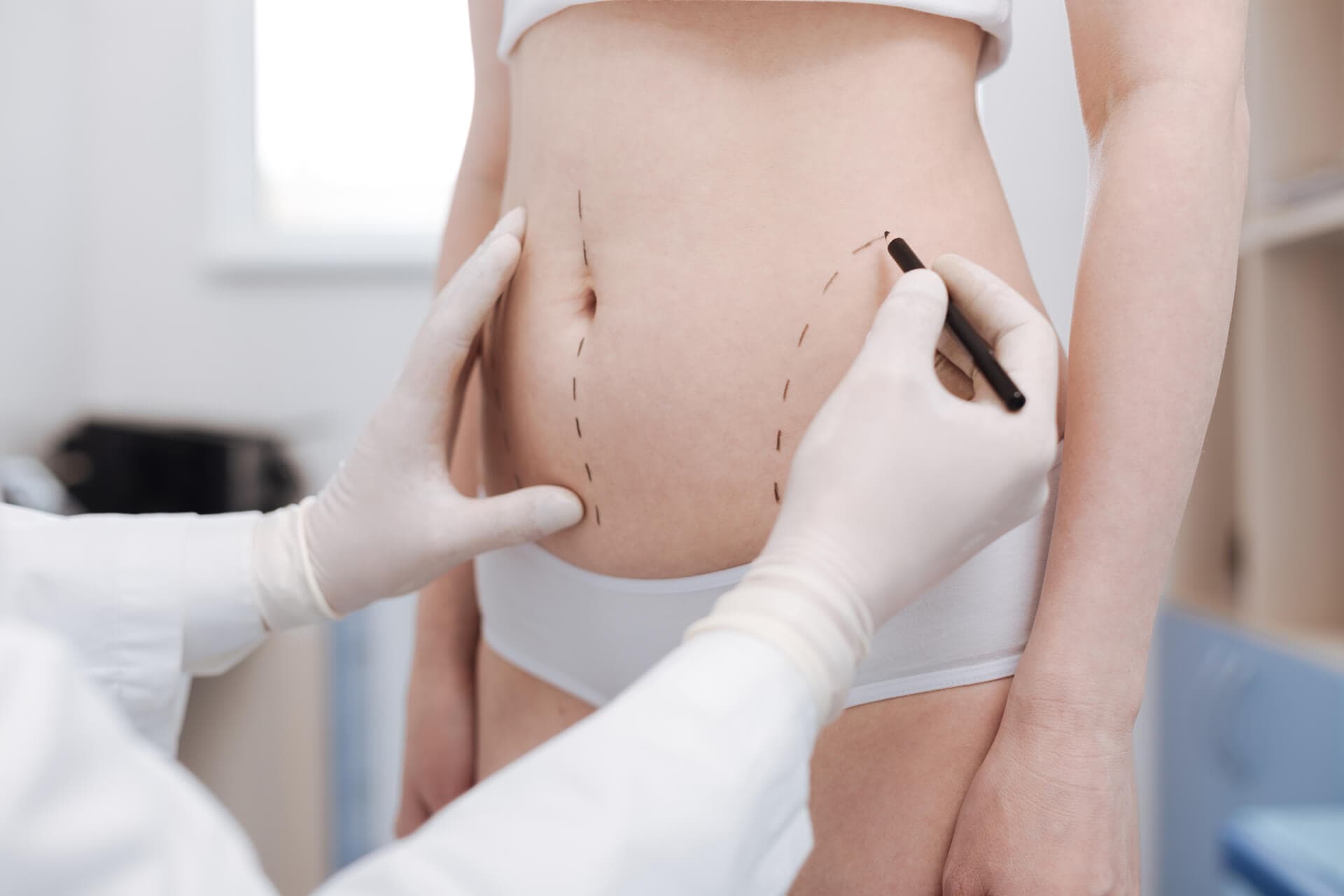 Preguntas frecuentes sobre la abdominoplastia