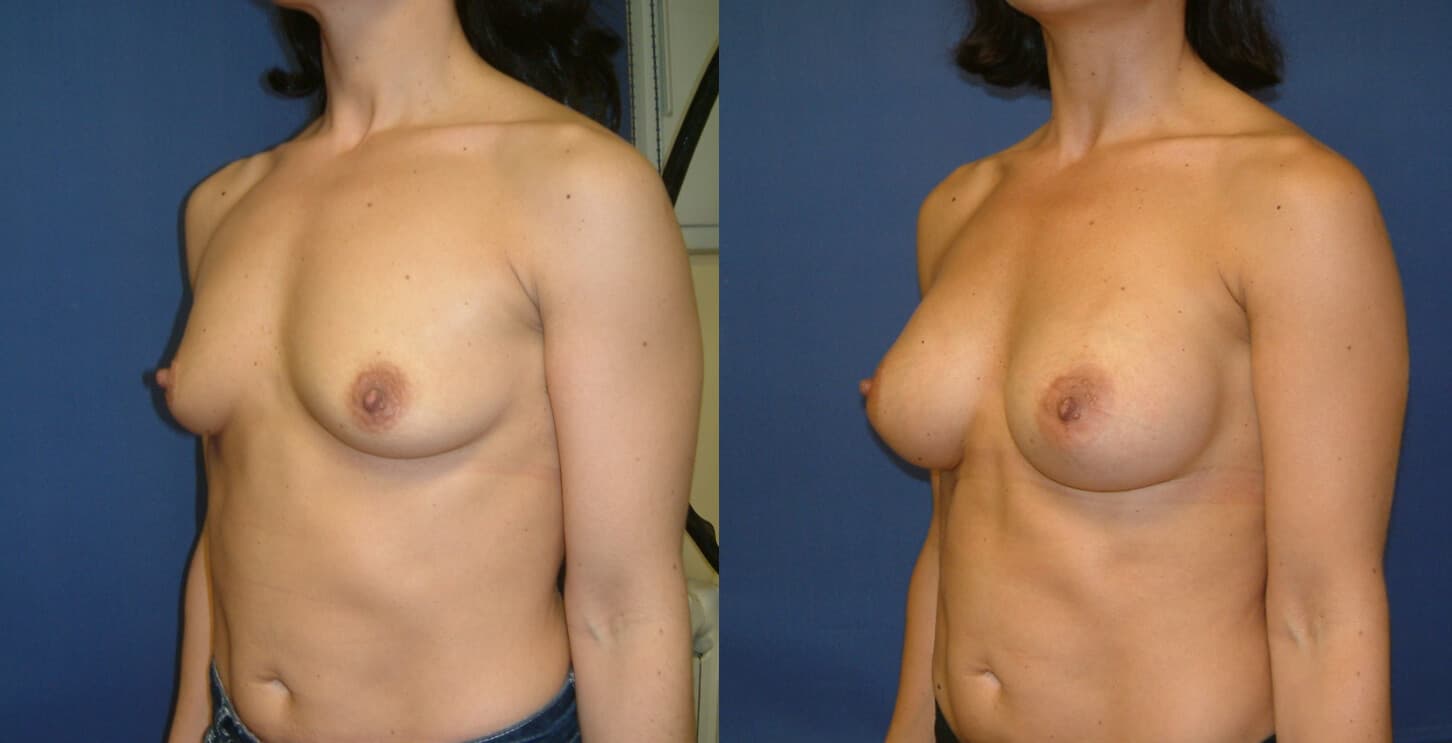 Aumento de mamas antes/después