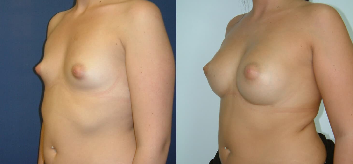 Aumento de mamas antes/después