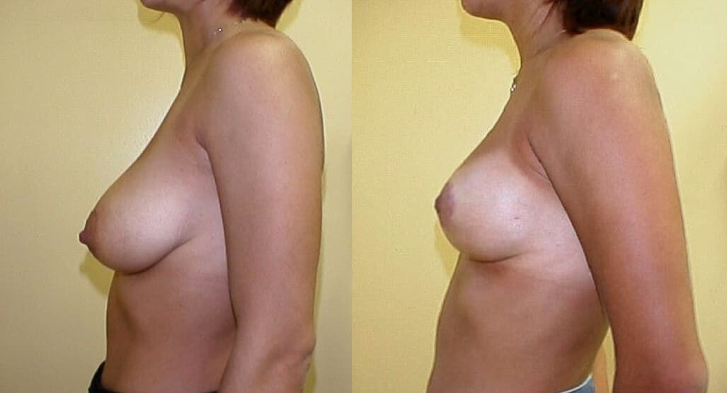 Elevación de mamas antes/después