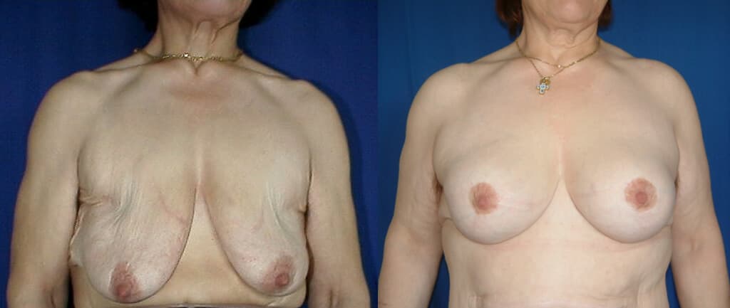 Elevación de mamas antes/después