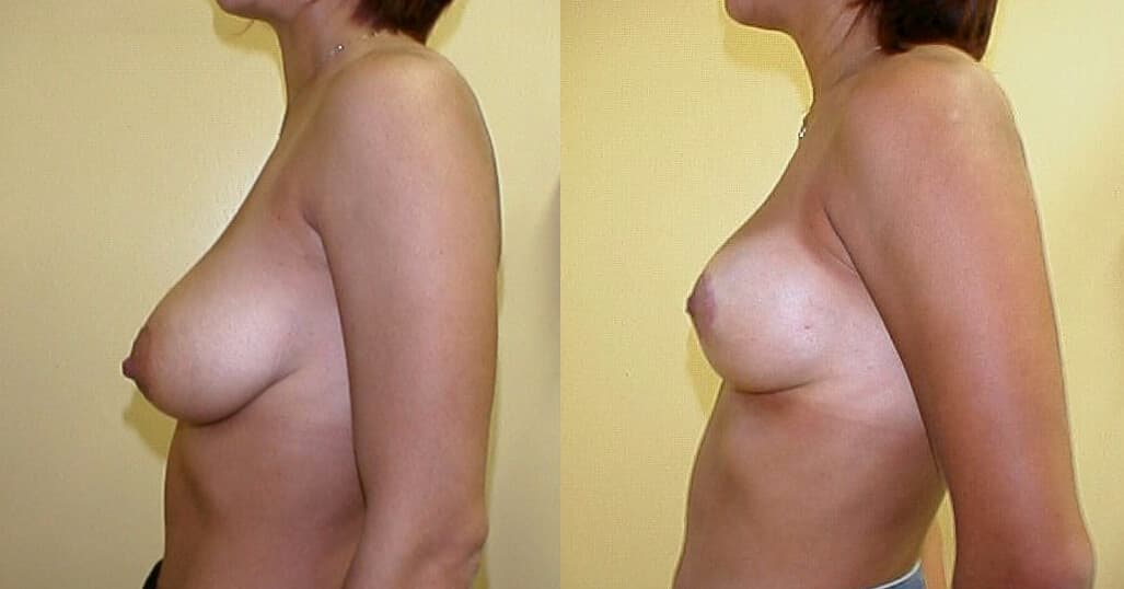 Reducción de mamas antes/después