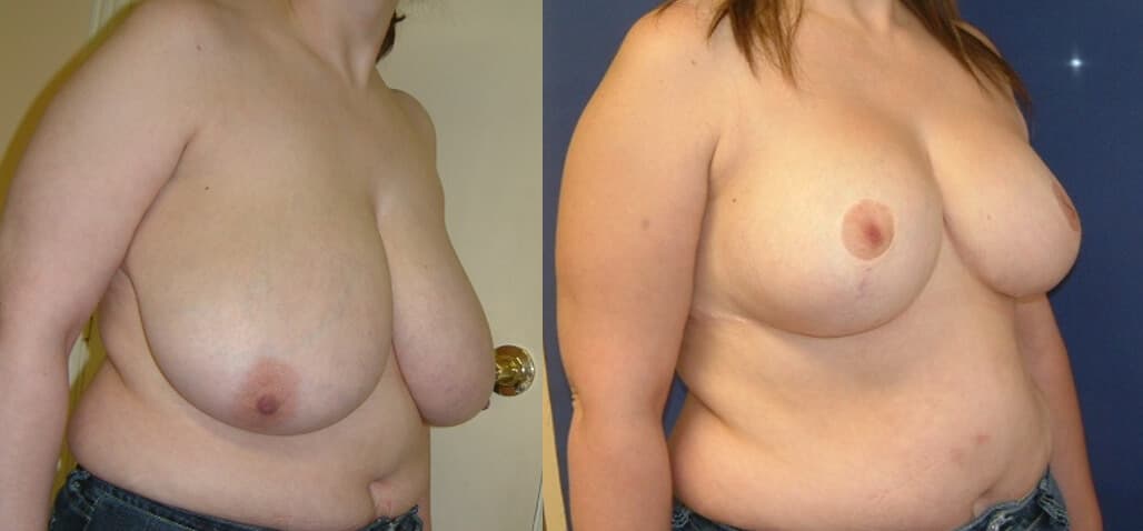 Reducción de mamas antes/después