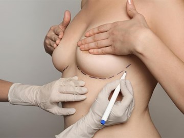 Preguntas frecuentes sobre la cirugía de aumento de senos